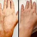Фотоомоложение рук на аппарате Ellipse Flex (Дания)