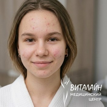 Лечение акне лазером в салоне ВИТАЛАЙН ВитаСПА Саратов