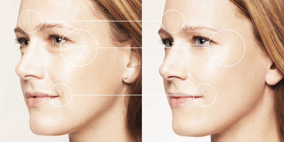Контурная пластика лица до и после | Салон красоты Вита СПА Саратов